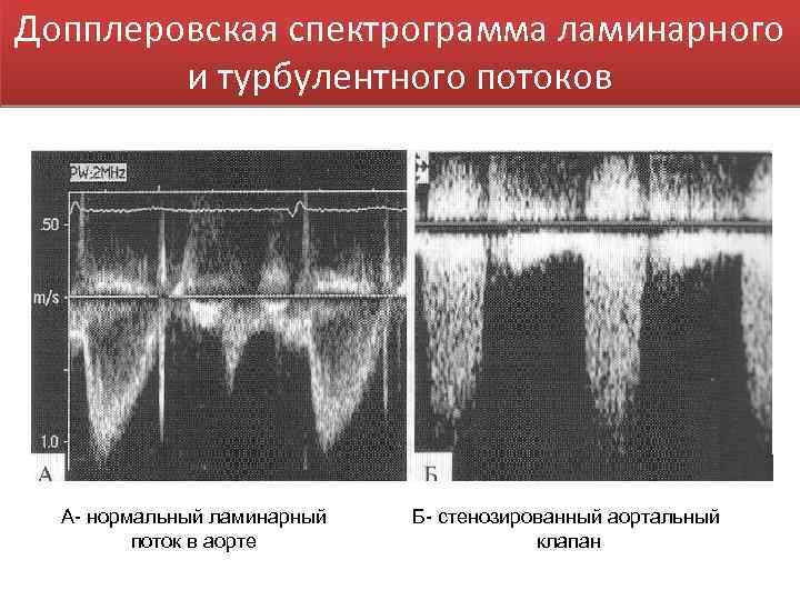 Допплеровская спектрограмма ламинарного и турбулентного потоков А- нормальный ламинарный поток в аорте Б- стенозированный