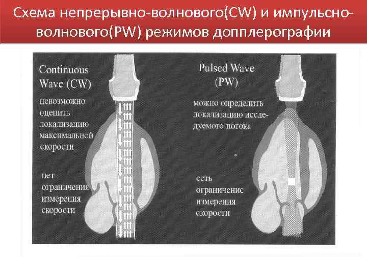 Схема непрерывно-волнового(CW) и импульсноволнового(PW) режимов допплерографии 