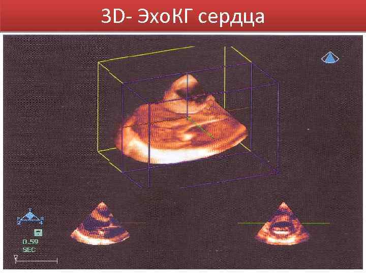 3 D- Эхо. КГ сердца 