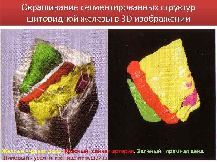 Окрашивание сегментированных структур щитовидной железы в 3 D изображении Желтый- правая доля, Красный- сонная