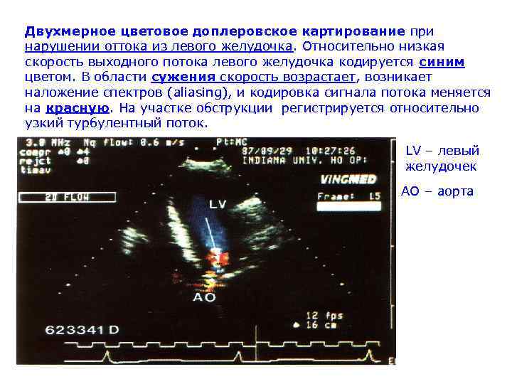 Двухмерное цветовое доплеровское картирование при нарушении оттока из левого желудочка. Относительно низкая скорость выходного