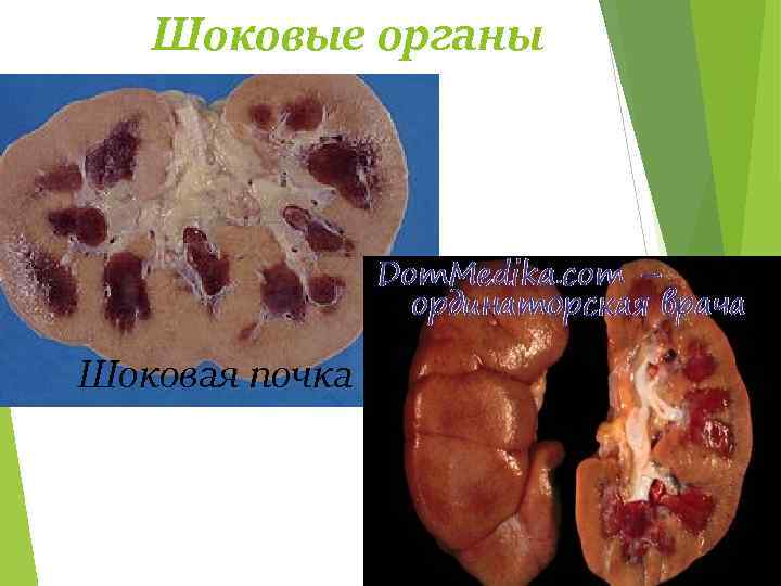 Шоковые органы Шоковая почка 