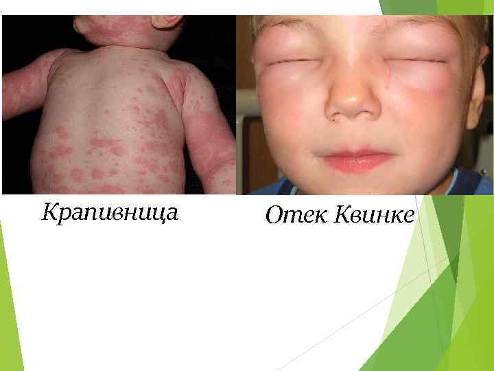 Крапивница Отек Квинке 