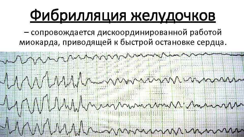 Фибрилляция желудочков – сопровождается дискоординированной работой миокарда, приводящей к быстрой остановке сердца. 