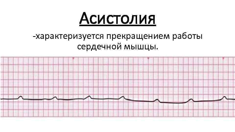 Асистолия -характеризуется прекращением работы сердечной мышцы. 