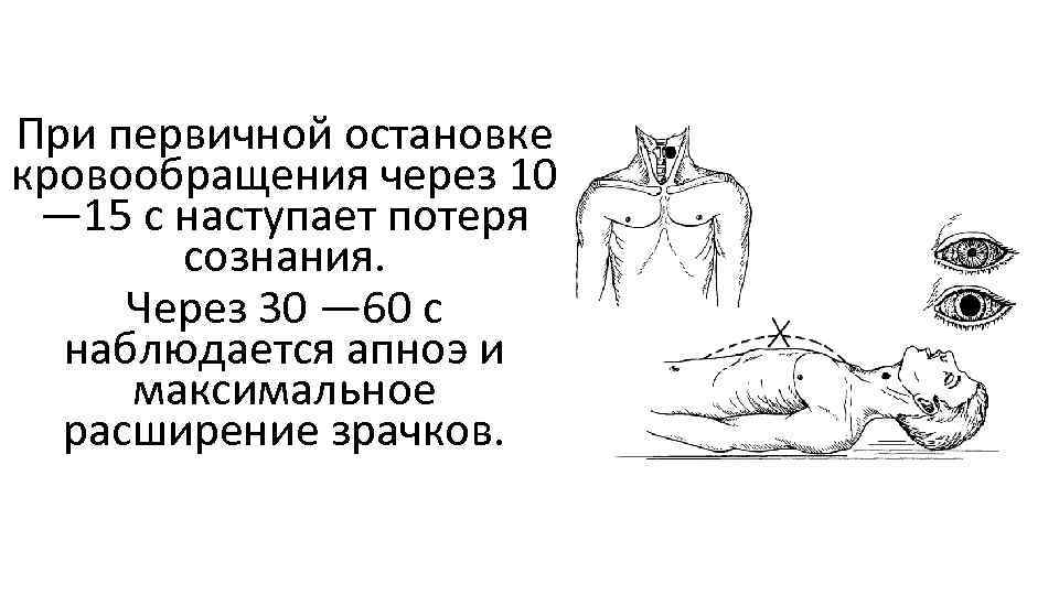 При первичной остановке кровообращения через 10 — 15 с наступает потеря сознания. Через 30