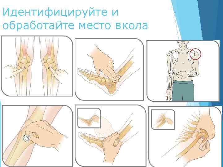 Идентифицируйте и обработайте место вкола 