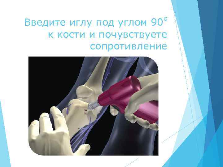 o Введите иглу под углом 90 к кости и почувствуете сопротивление 