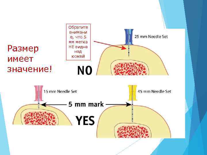 Размер имеет значение! Обратите внимани е, что 5 мм метка НЕ видна над кожей