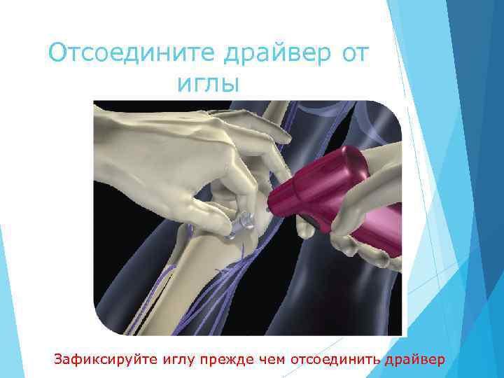 Отсоедините драйвер от иглы Зафиксируйте иглу прежде чем отсоединить драйвер 
