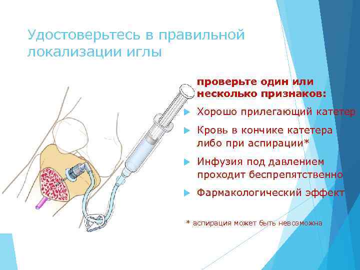 Удостоверьтесь в правильной локализации иглы проверьте один или несколько признаков: Хорошо прилегающий катетер Кровь