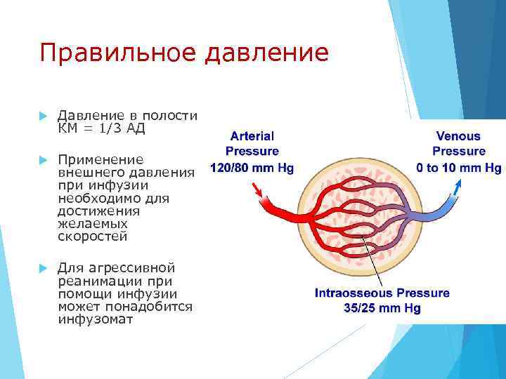 Правильное давление Давление в полости КМ = 1/3 АД Применение внешнего давления при инфузии