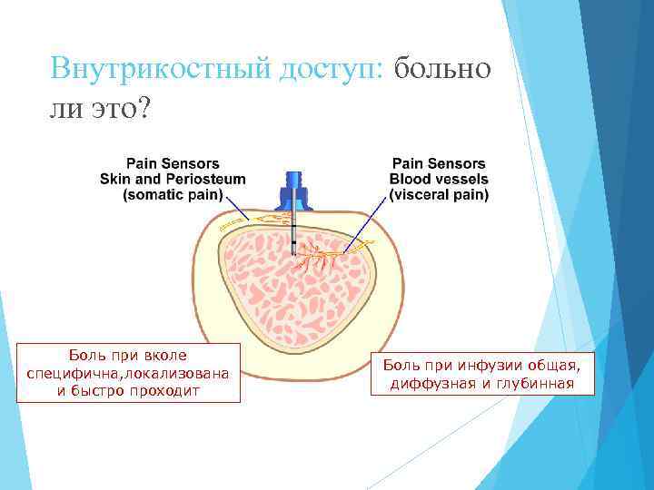 Внутрикостный доступ: больно ли это? Боль при вколе специфична, локализована и быстро проходит Боль