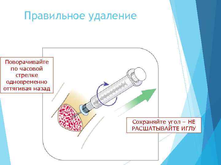Правильное удаление Поворачивайте по часовой стрелке одновременно оттягивая назад Сохраняйте угол – НЕ РАСШАТЫВАЙТЕ