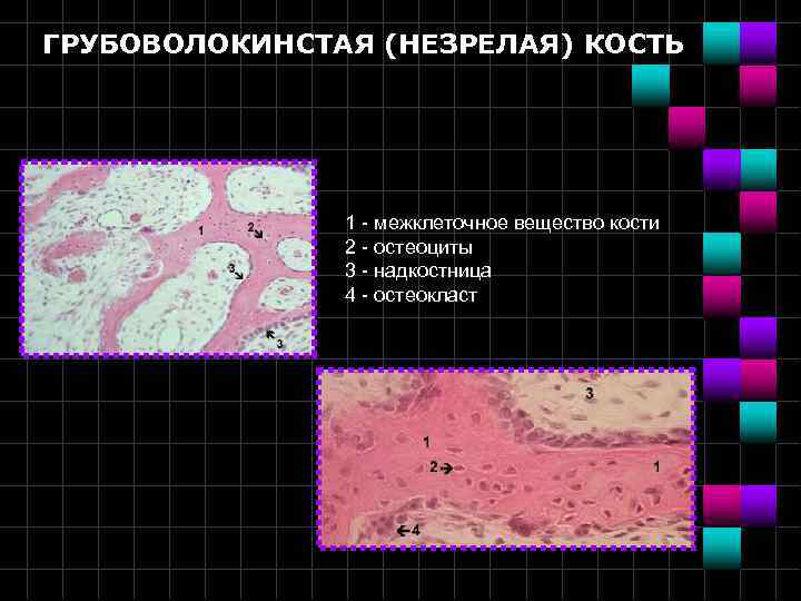 ГРУБОВОЛОКИНСТАЯ (НЕЗРЕЛАЯ) КОСТЬ 1 - межклеточное вещество кости 2 - остеоциты 3 - надкостница