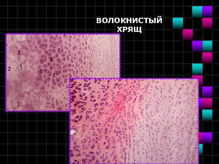 ВОЛОКНИСТЫЙ ХРЯЩ 
