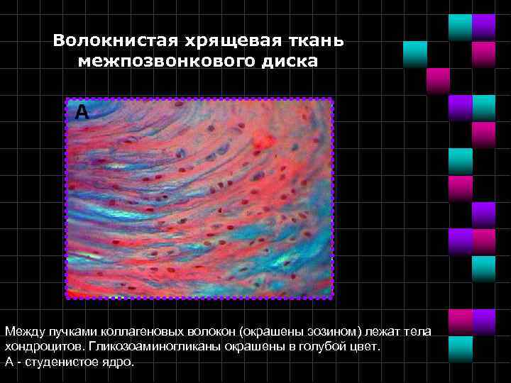 Волокнистая хрящевая ткань межпозвонкового диска Между пучками коллагеновых волокон (окрашены эозином) лежат тела хондроцитов.