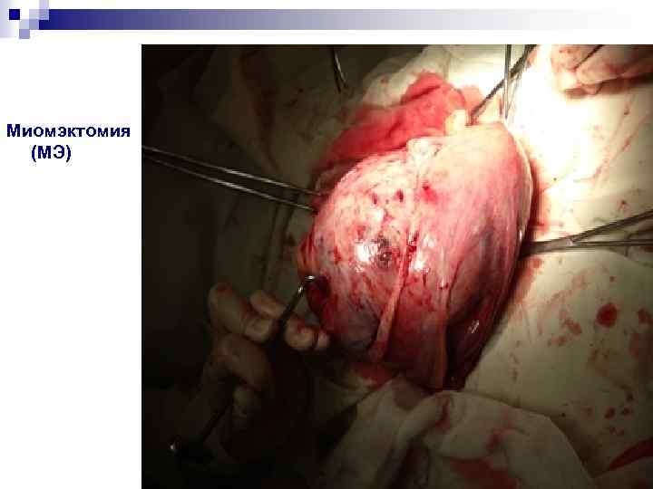 Миомэктомия (МЭ) 