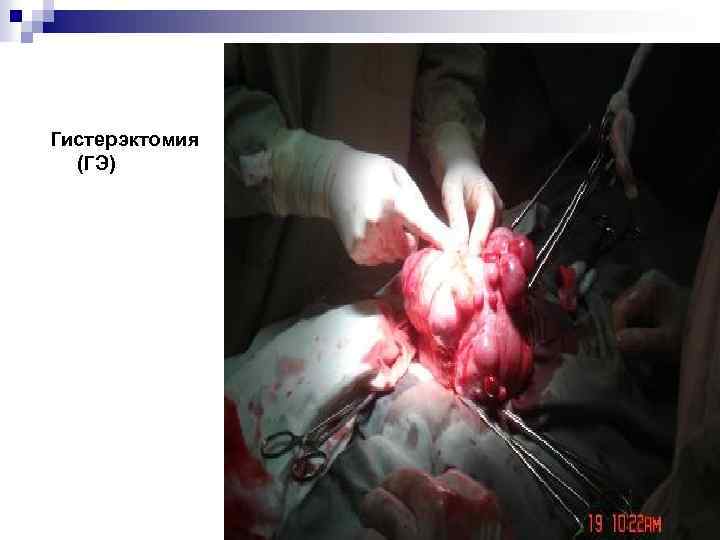 Гистерэктомия (ГЭ) 