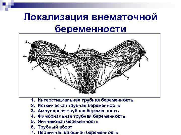 Локализация внематочной беременности 1. 2. 3. 4. 5. 6. 7. Интерстициальная трубная беременность Истмическая