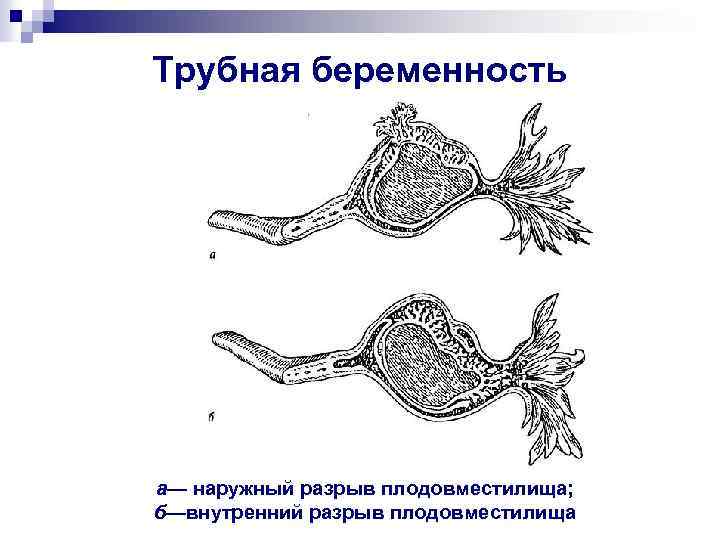 Трубная беременность а— наружный разрыв плодовместилища; б—внутренний разрыв плодовместилища 