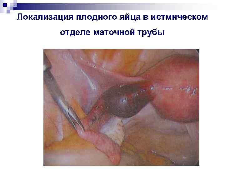 Локализация плодного яйца в истмическом отделе маточной трубы 