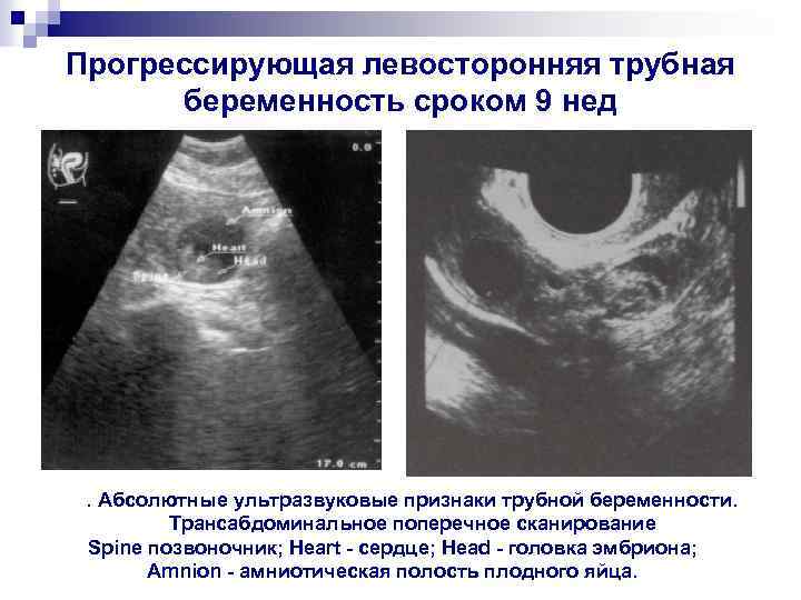 Прогрессирующая левосторонняя трубная беременность сроком 9 нед . Абсолютные ультразвуковые признаки трубной беременности. Трансабдоминальное
