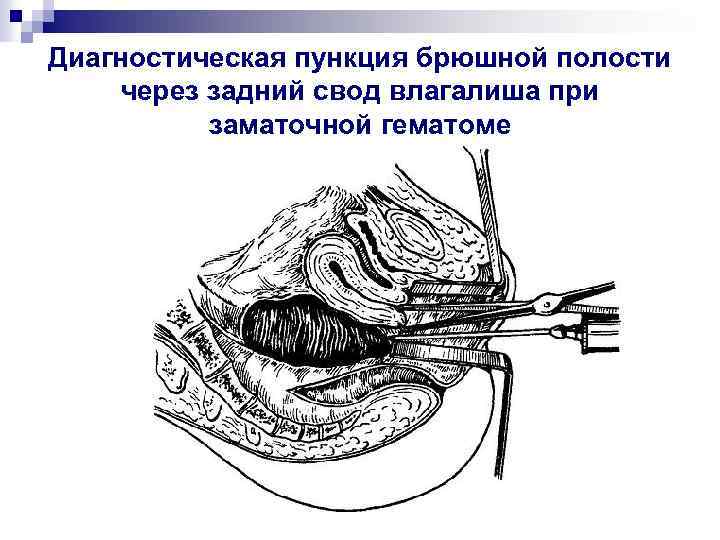 Диагностическая пункция брюшной полости через задний свод влагалиша при заматочной гематоме 