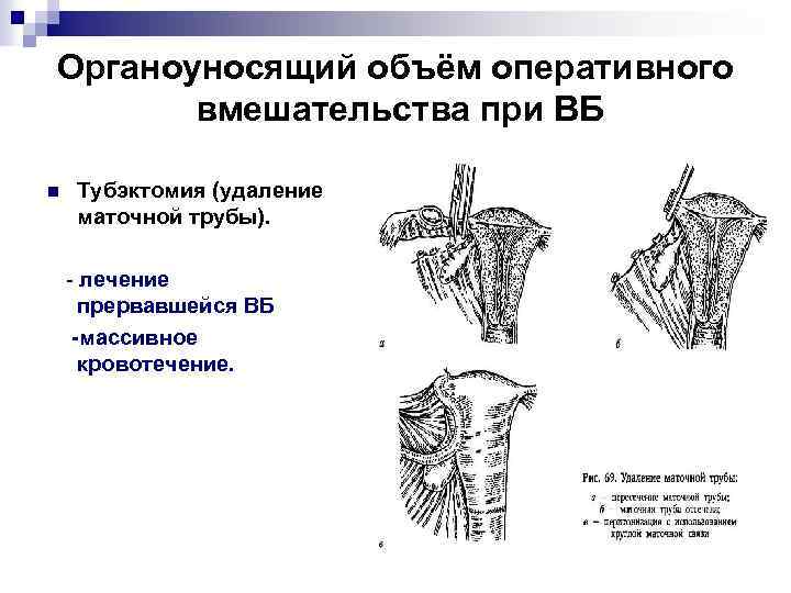 Органоуносящий объём оперативного вмешательства при ВБ n Тубэктомия (удаление маточной трубы). - лечение прервавшейся