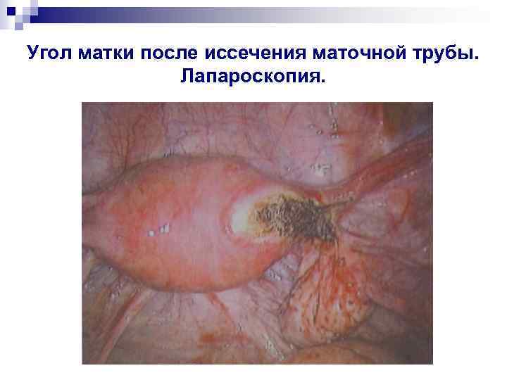 Угол матки после иссечения маточной трубы. Лапароскопия. 