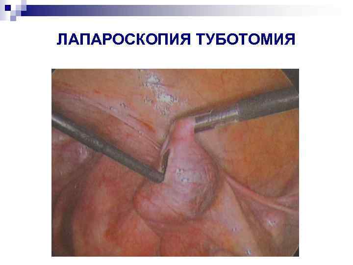 ЛАПАРОСКОПИЯ ТУБОТОМИЯ 