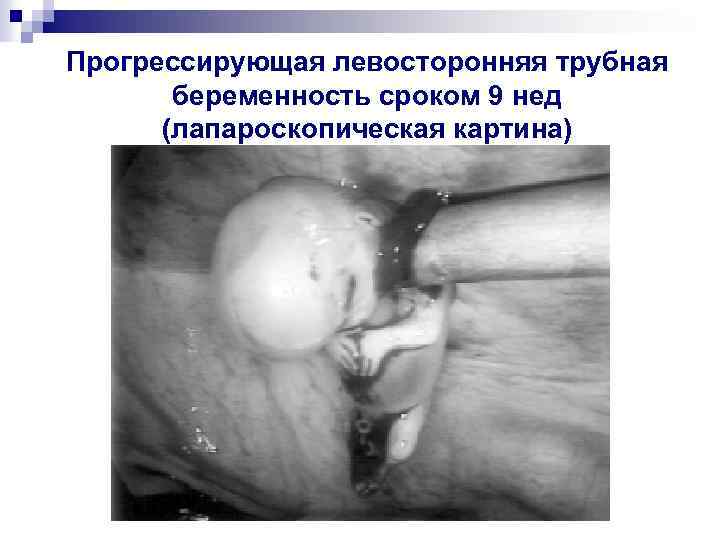 Прогрессирующая левосторонняя трубная беременность сроком 9 нед (лапароскопическая картина) 