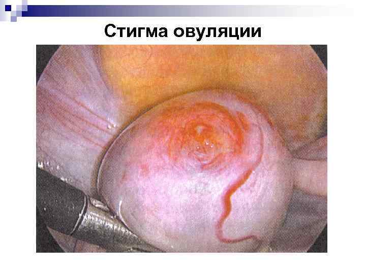 Стигма овуляции 