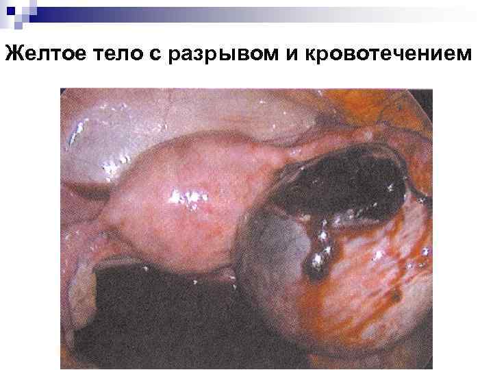 Желтое тело с разрывом и кровотечением 