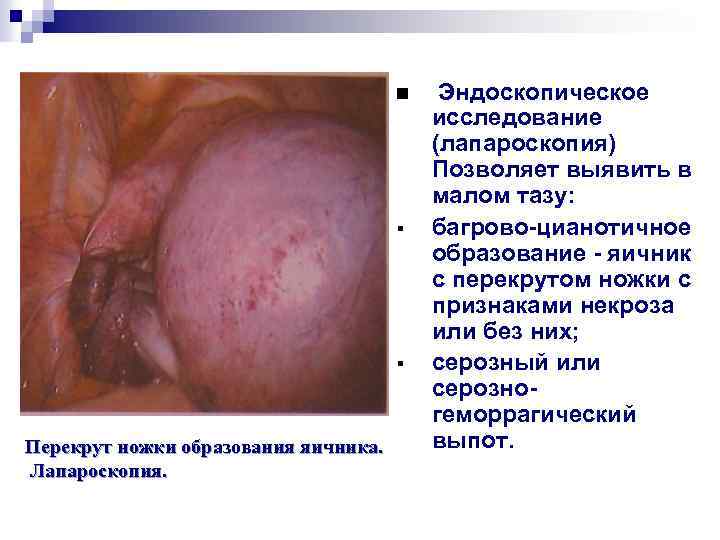 n § § Перекрут ножки образования яичника. Лапароскопия. Эндоскопическое исследование (лапароскопия) Позволяет выявить в