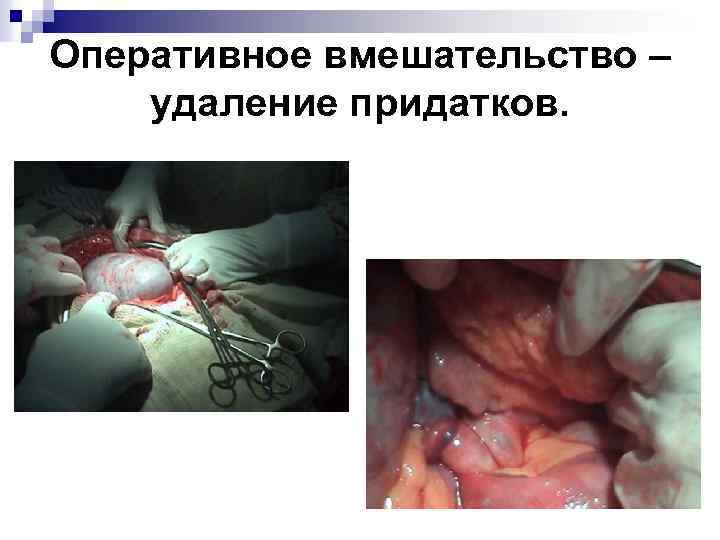 Оперативное вмешательство – удаление придатков. 