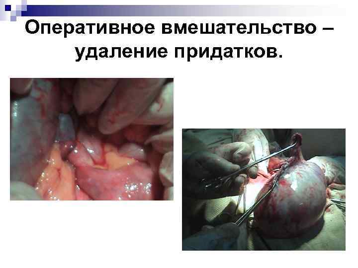 Оперативное вмешательство – удаление придатков. 