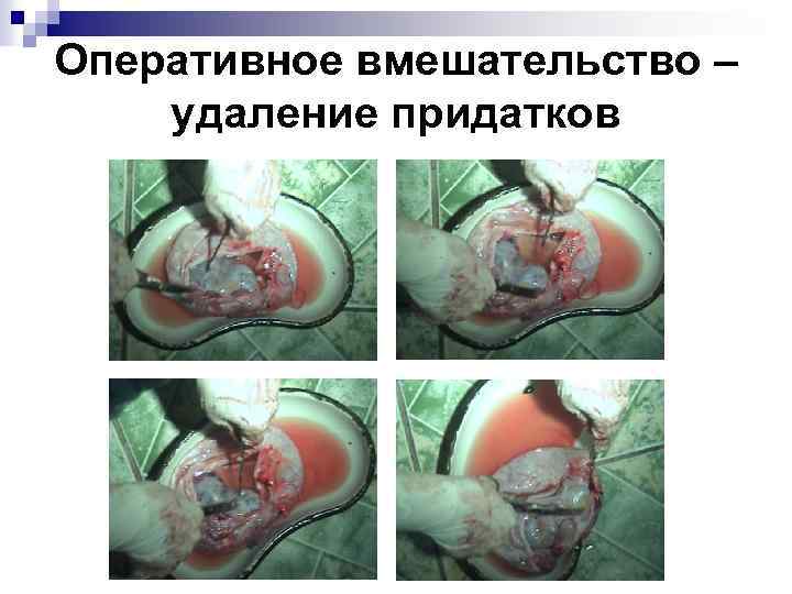 Оперативное вмешательство – удаление придатков 