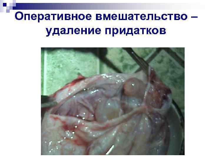 Оперативное вмешательство – удаление придатков 