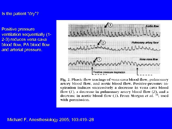 Is the patient “dry”? Positive pressure ventilation sequentially (12 -3) reduces vena cava blood