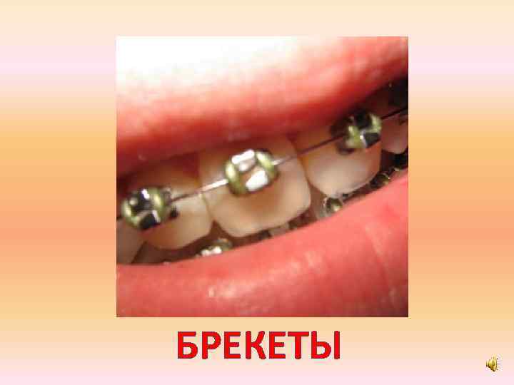 БРЕКЕТЫ 