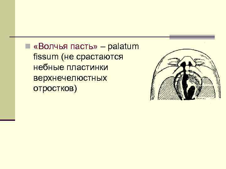 n «Волчья пасть» – palatum fissum (не срастаются небные пластинки верхнечелюстных отростков) 