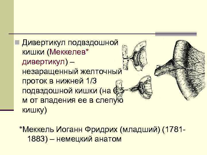 n Дивертикул подвздошной кишки (Меккелев* дивертикул) – незаращенный желточный проток в нижней 1/3 подвздошной