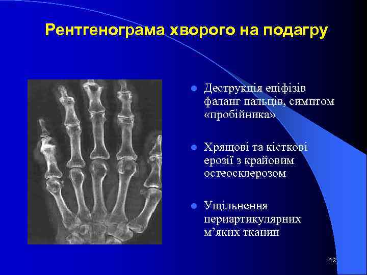 Рентгенограма хворого на подагру l Деструкція епіфізів фаланг пальців, симптом «пробійника» l Хрящові та