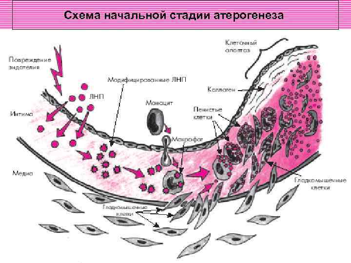 Схема начальной стадии атерогенеза 