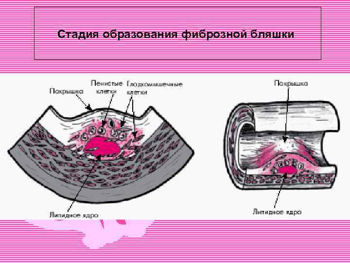 Стадия образования фиброзной бляшки 