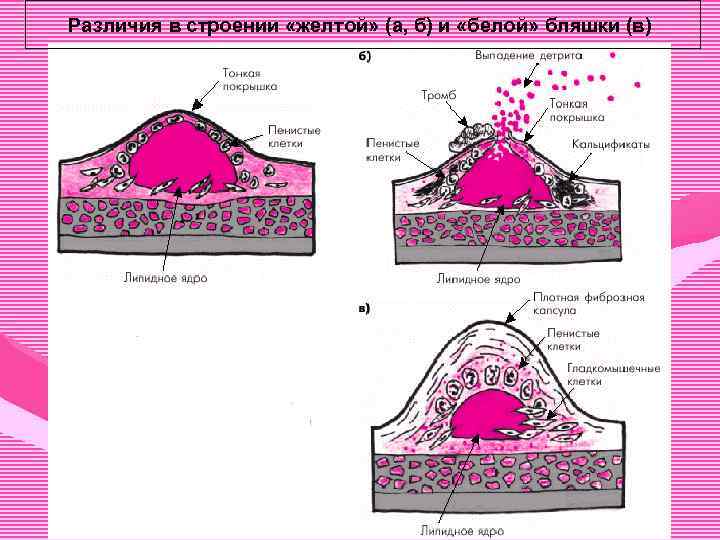 Различия в строении «желтой» (а, б) и «белой» бляшки (в) 