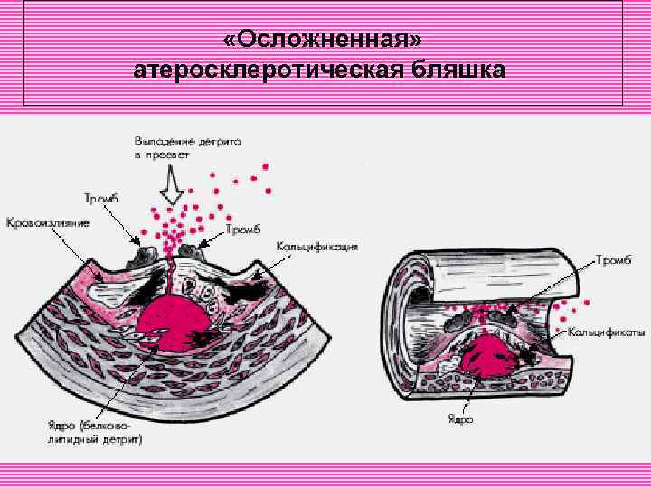  «Осложненная» атеросклеротическая бляшка 