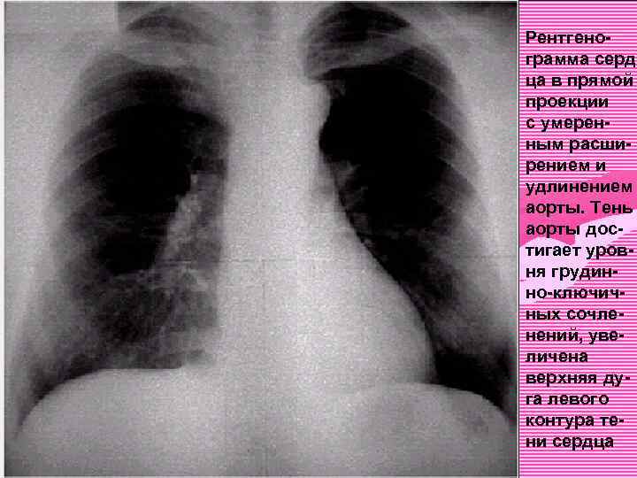 Рентгенограмма серд ца в прямой проекции с умеренным расширением и удлинением аорты. Тень аорты