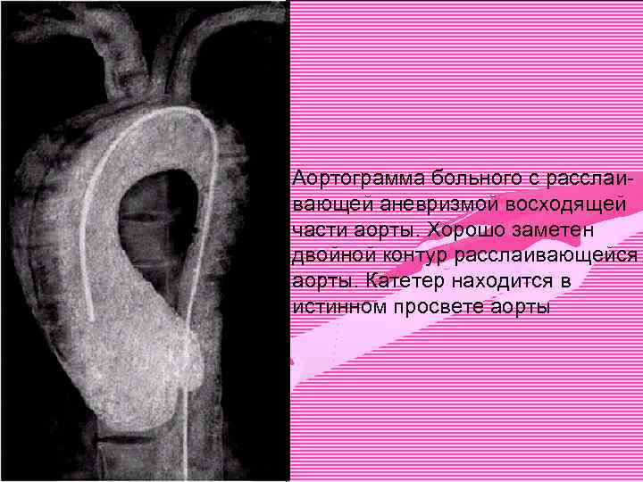 Аортограмма больного с расслаивающей аневризмой восходящей части аорты. Хорошо заметен двойной контур расслаивающейся аорты.